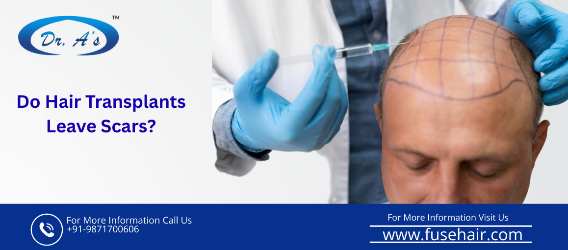 hair transplant scar