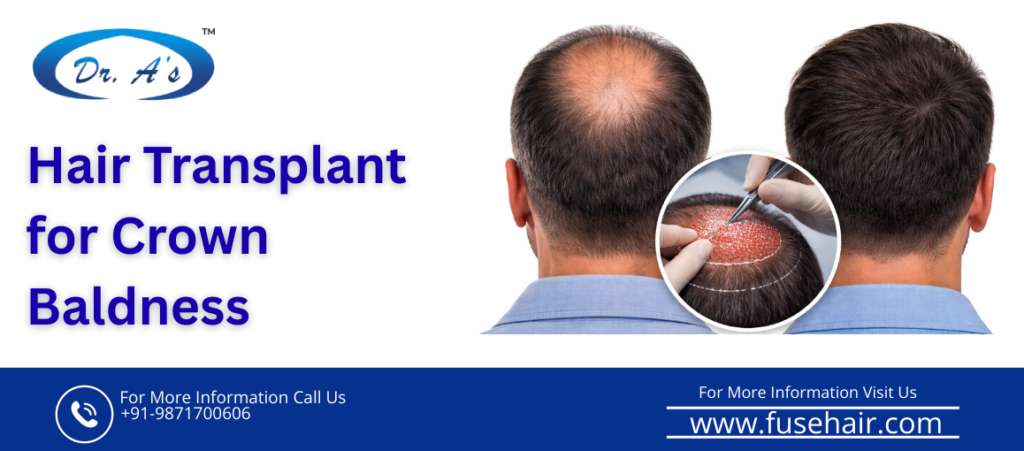 crown baldness