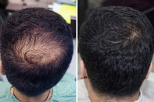 hair replacement surgery before after