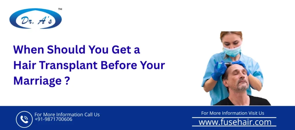 hair transplant before marriage