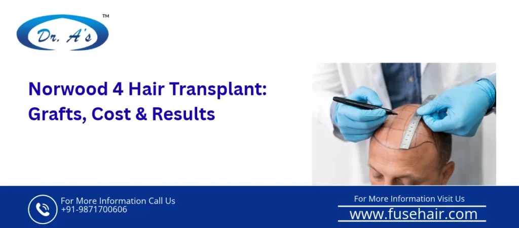 norwood scale 4 hair transplant