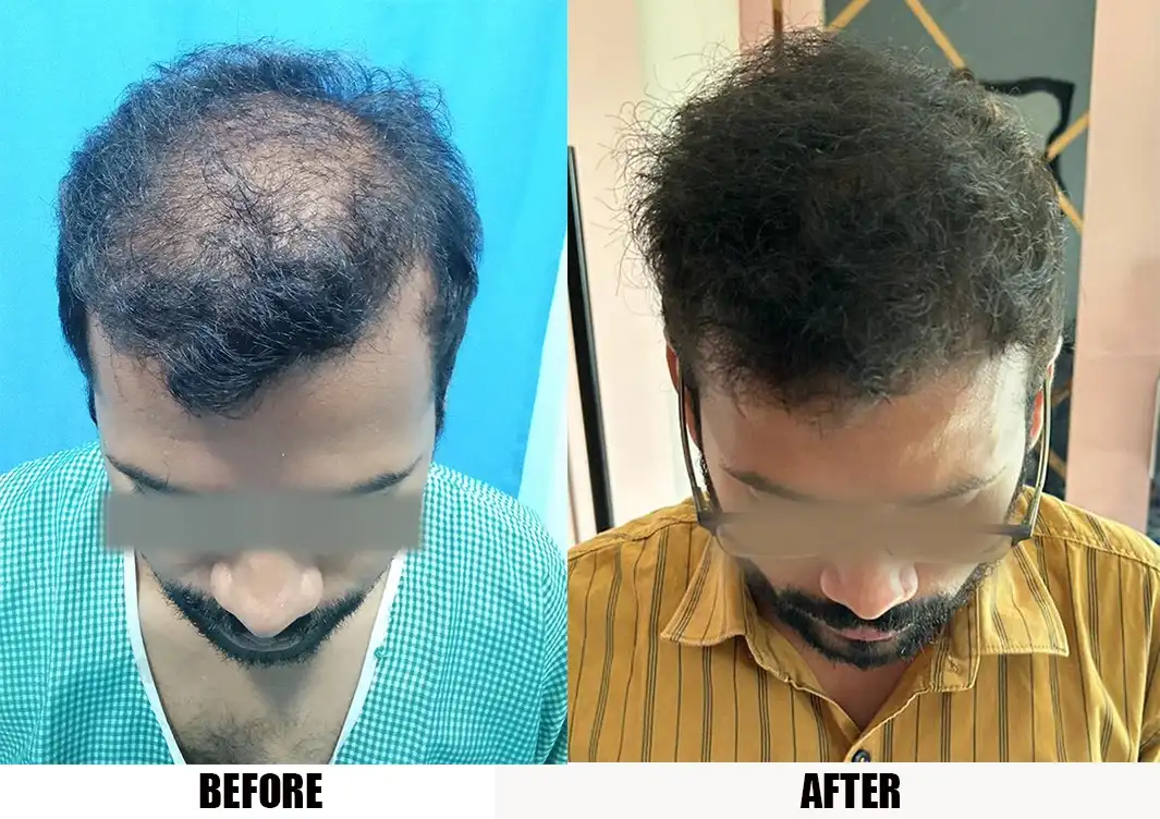 Best Hair Patch in Delhi, Mumbai and Noida