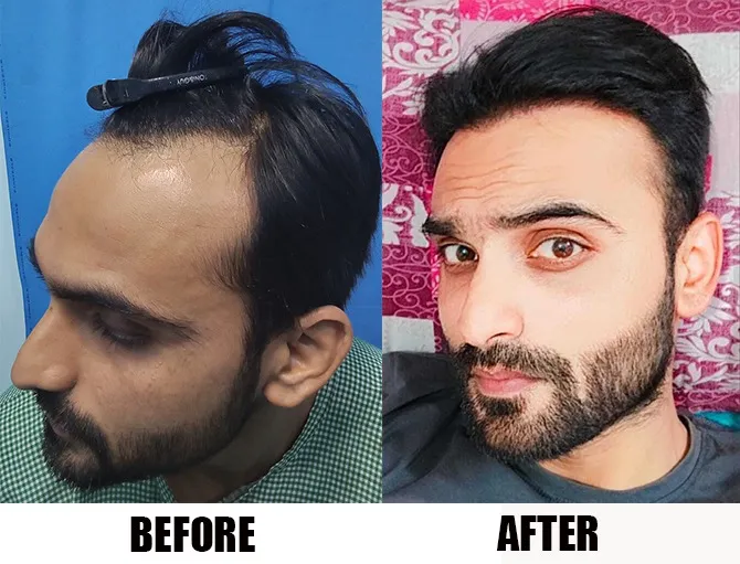 Best Hair Transplant Clinic In India  Hair Transplant Cost