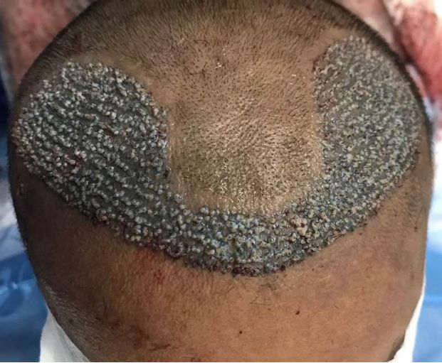 Hair Transplant Holes and Trypophobia  Aventus Clinic