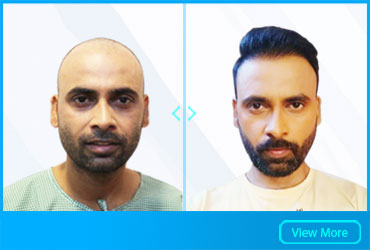 Hair Transplant