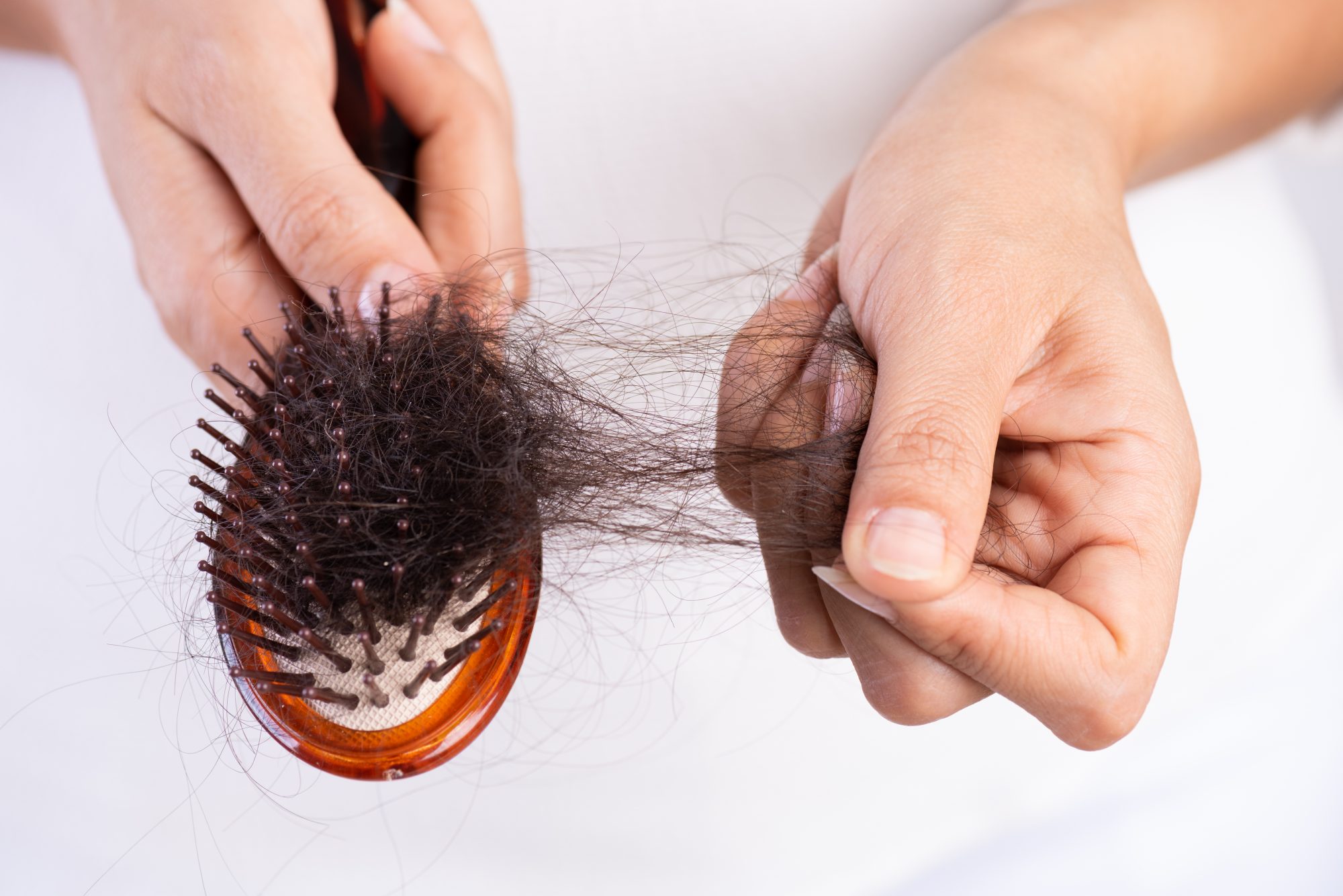 Hair loss Who gets and causes