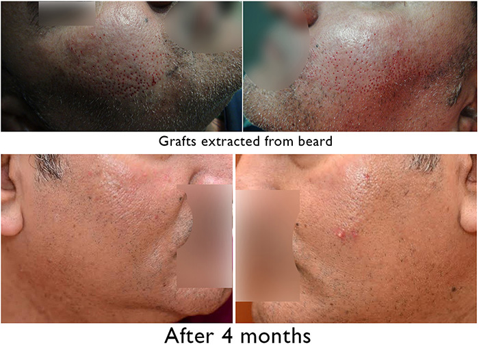 Beard Hair Removal No visible scarring - Dr. A's Clinic Beard Hair Removal No visible scarring - Dr. A's Clinic