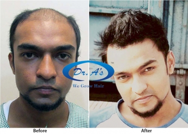 Facts To Know Before Getting Hair Transplant In Delhi - Dr. A's Clinic
