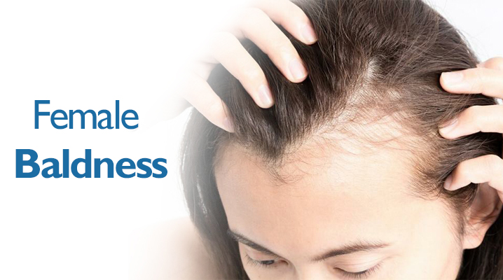 Facts to know about Female Baldness - Dr. A's Clinic