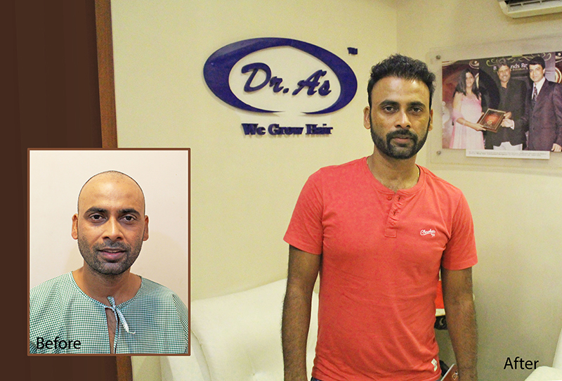 Get a successful Hair transplant done with the best Hair transplant clinic  in Noida - Dr. A's Clinic