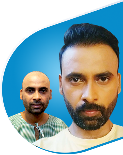 Does Hair transplant treatment work best for alopecia areata