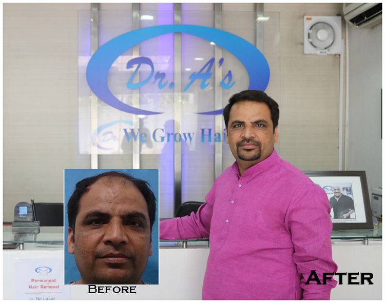 How Should You Choose a Perfect Hair Transplant Clinic in Delhi? - Dr. A's Clinic How Should You Choose a Perfect Hair Transplant Clinic in Delhi? - Dr. A's Clinic