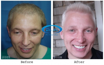 Failed Hair Transplant Can You Avoid or Fix It  DR Emrah CINIK