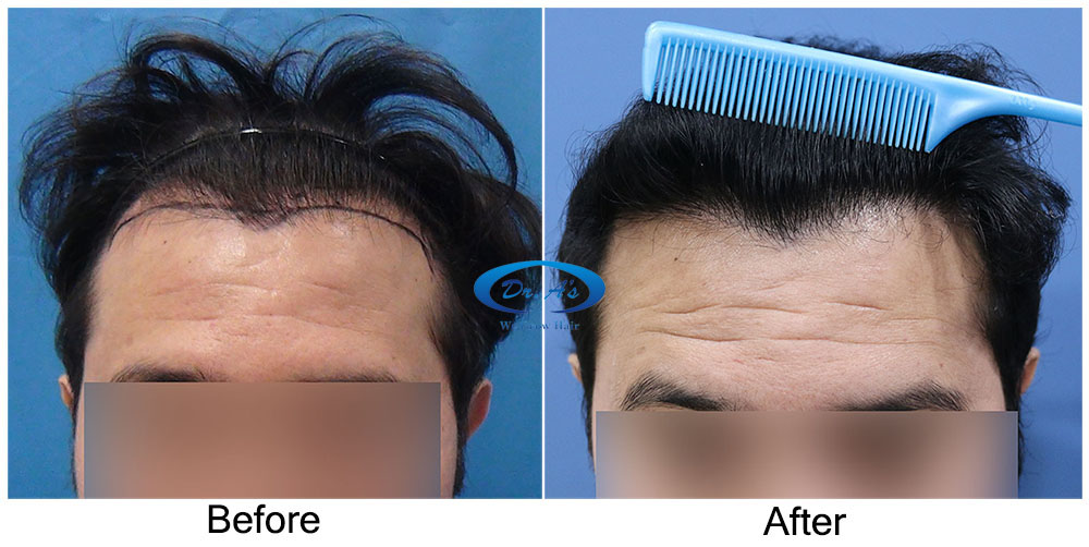 Long Hair Transplant