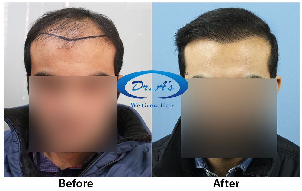 Is Hair Transplant Permanent - Dr. A's Clinic