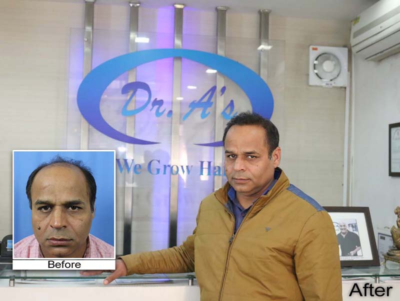 Know about Hair Transplant Cost - Dr. A's Clinic Know about Hair Transplant Cost - Dr. A's Clinic