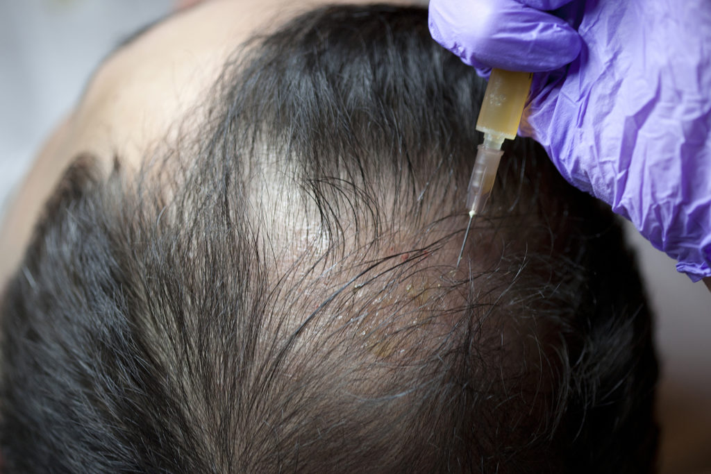 PRP Hair Results: How Long to See Results?
