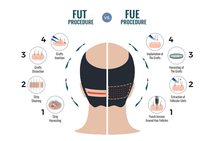 FUT Hair Transplant 2 Techniques of Hair Transplant Treatment05 57 30