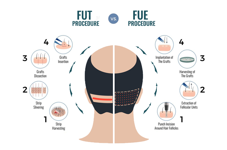 Our Techniques  Hair Transplantation