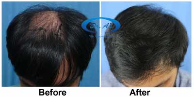 Additional Hair Transplant  SHAAN KHAN HAIR DESIGNER SALON  ADDITIONAL HAIR  TRANSPLANT  HAIR WEAVING  SPA  STRAIGHTENING  COLOURING  BRIDAL  MAKEOVER  ACNE TREATMENT  KOLKATA  SIMPARK MALL  NEW MARKET  ESPLANADE