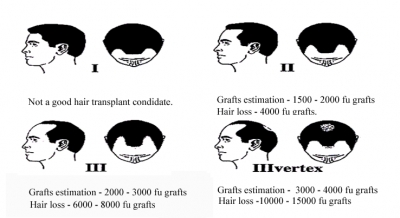 Norwood classification male pattern baldness