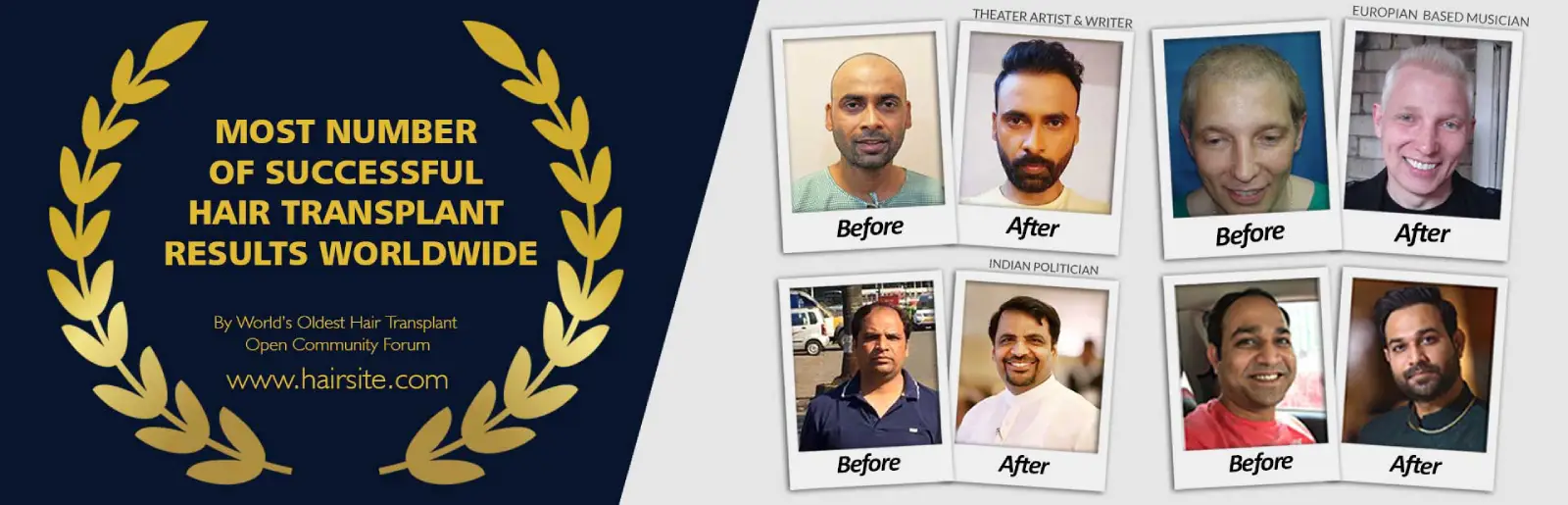 Best hair transplant in Delhi