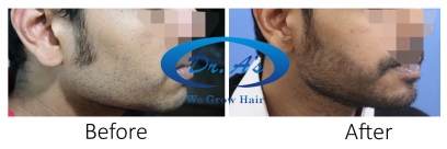 Beard Hair Transplant in Delhi