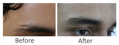 Eyebrow Restoration