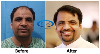 FUE Hair Transplant