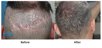 Hair Transplant on Scar