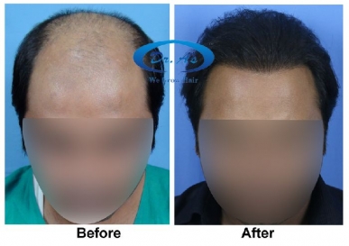 Best hair transplant in Delhi NCR