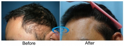 hair regrowth solution in india