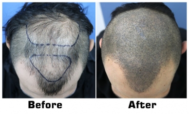 Scalp Mirco Pigmentation in Delhi