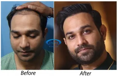 FUE Hair Transplant