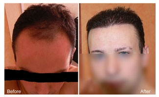Hair Transplant Photogallery - Dr. A's Clinic Hair Transplant Photogallery - Dr. A's Clinic