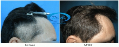 Sub Gallery Traction alopecia