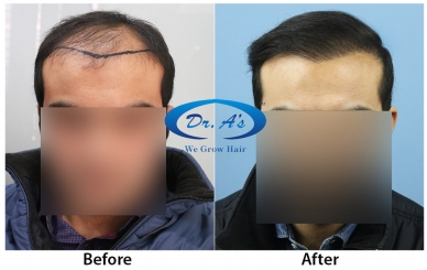 Hair Transplant Photogallery - Dr. A's Clinic