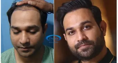 hair transplant cost in delhi