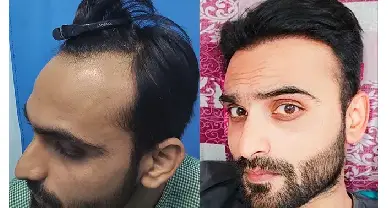 hair transplant cost in delhi