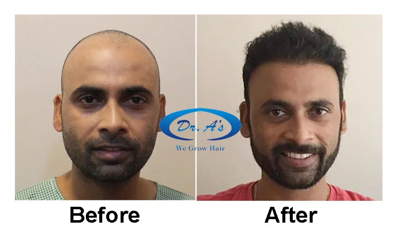 hair transplant in Delhi