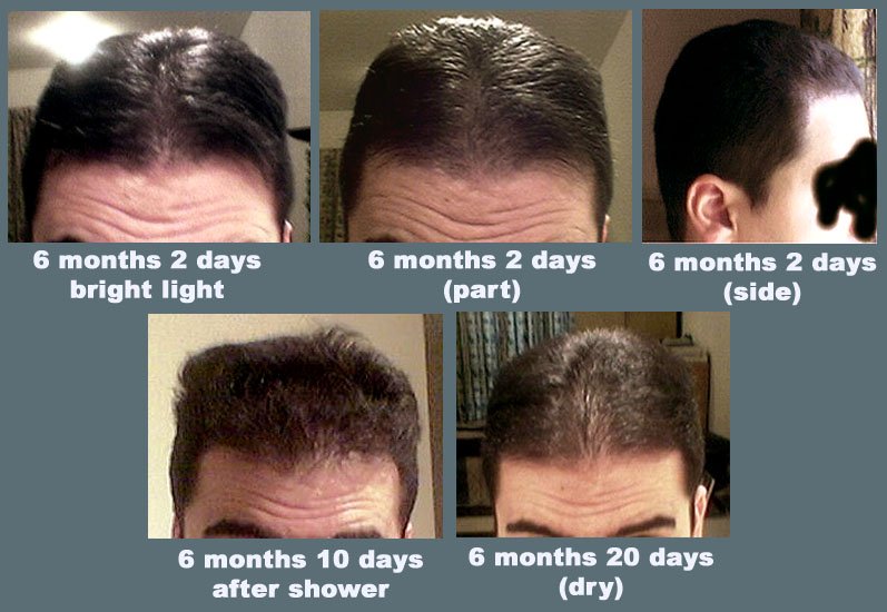 Important Steps to Follow After a Hair Transplant