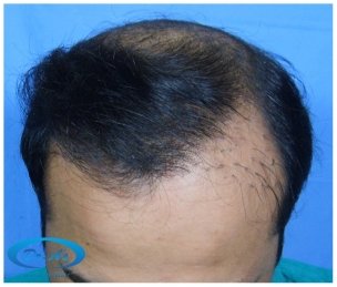 A beautiful hair transplant vandalized (picture 4)