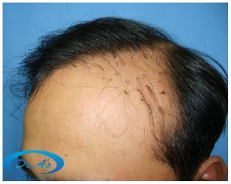 A beautiful hair transplant vandalized (picture 5)