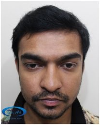 After 6 months picture 1