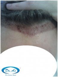 After graft placement