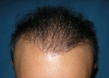 After picture 2