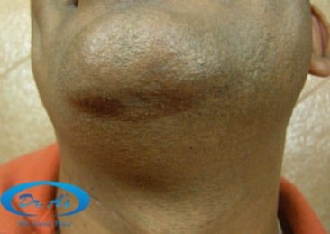 Beard donor area (5 months after)