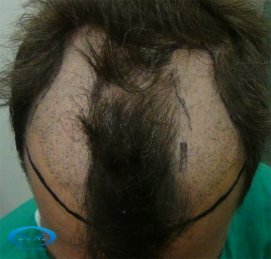 Before picture (pre- op)