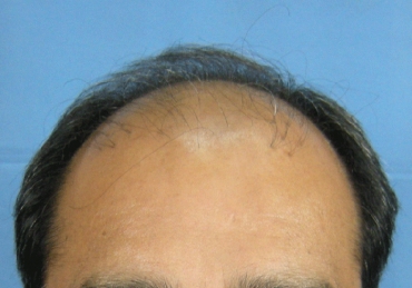 Before picture 1