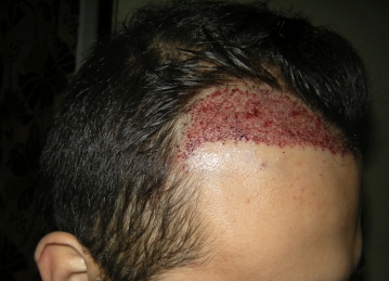 Graft placement picture 2